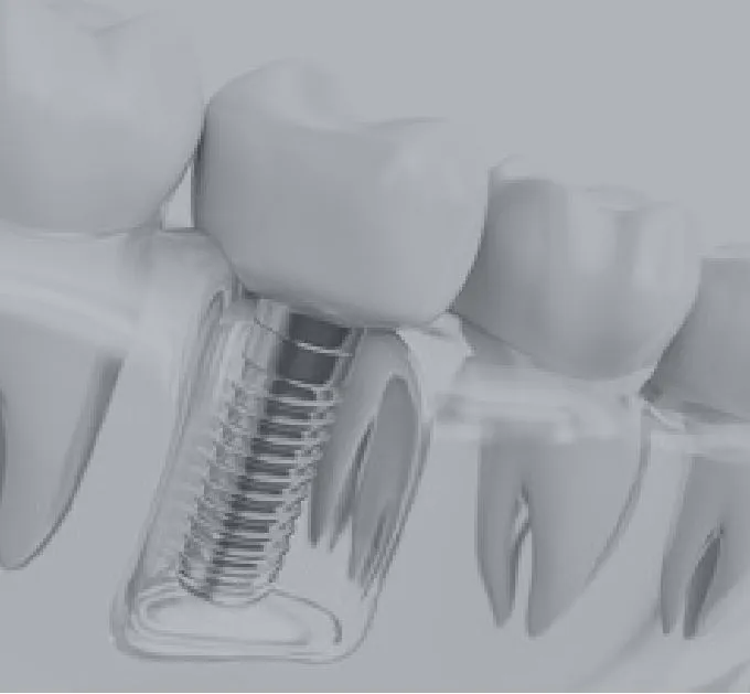 インプラント治療